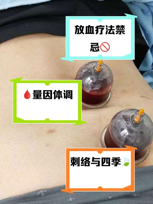 2026年4月点刺放血适宜日子 2026年3月点刺放血吉日查询-第1张图片